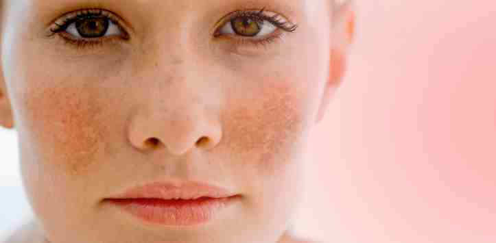 hyperpigmentation