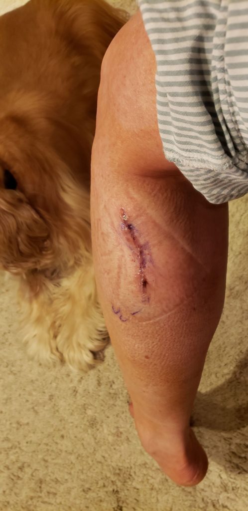 Leg showing scar from melanoma cancer surgery