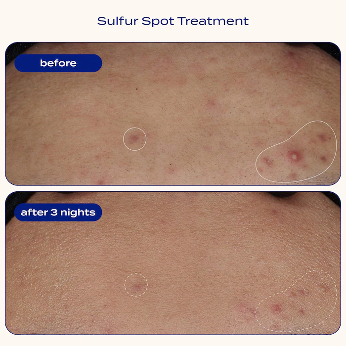 https://d3vlxf0ngetfml.cloudfront.net/blog-media/original_images/Banu_Sulfur_Spot_Treatment_for_Acne_and_Blemishes_02.webp
