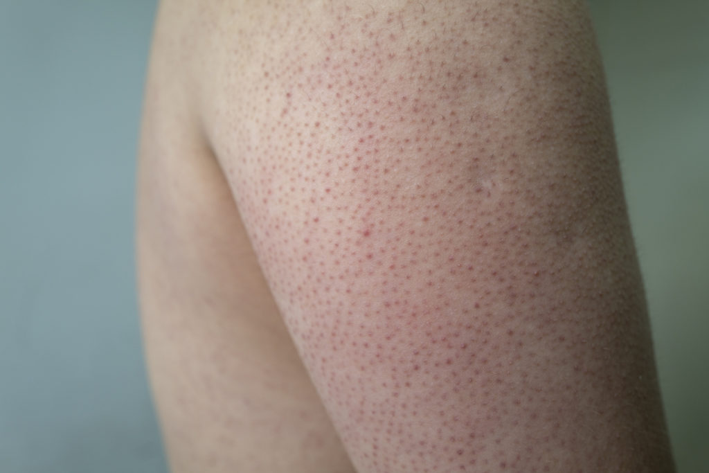 What Is Kerastosis Pilaris And How To Get Rid Of This Common Skin Condition 