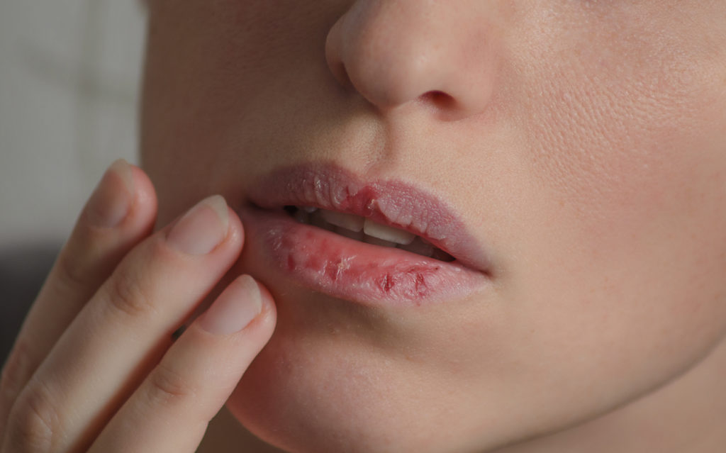 Lip Treatments vs. Balms