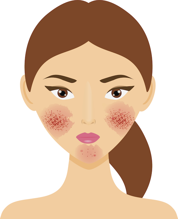 rosacea redness